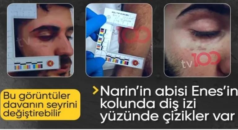 Narin'in tutuklu yargılanan abisinin kolundaki ısırık ve yüzündeki morluk izleri...